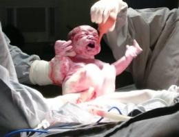 Parto na penumbra; parto humanizado; parto cesariana; parto respeitoso; parto cesárea; cesárea humanizada; Bem-Nascida